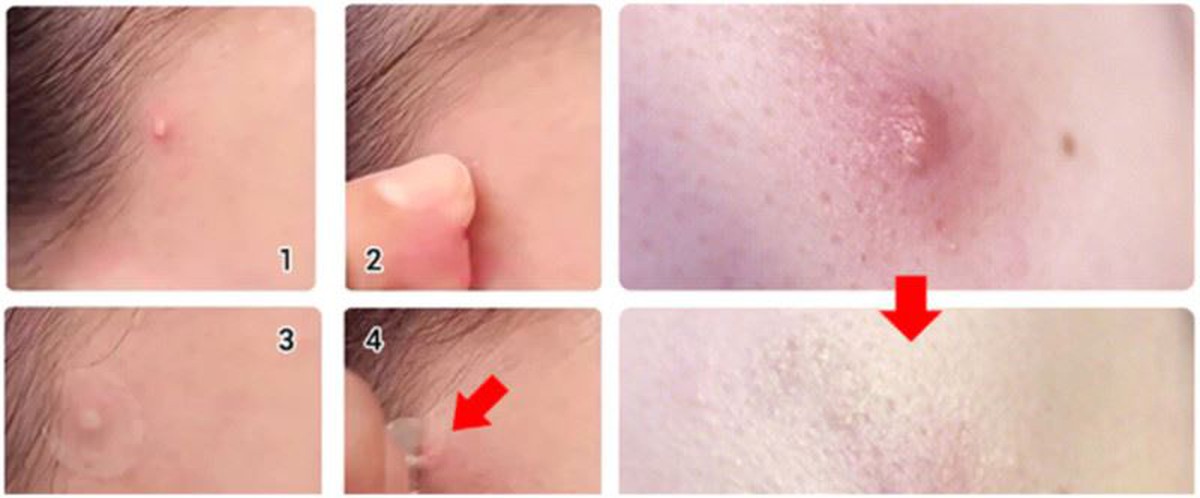 microneedle Acne patch microneedle Acne patch